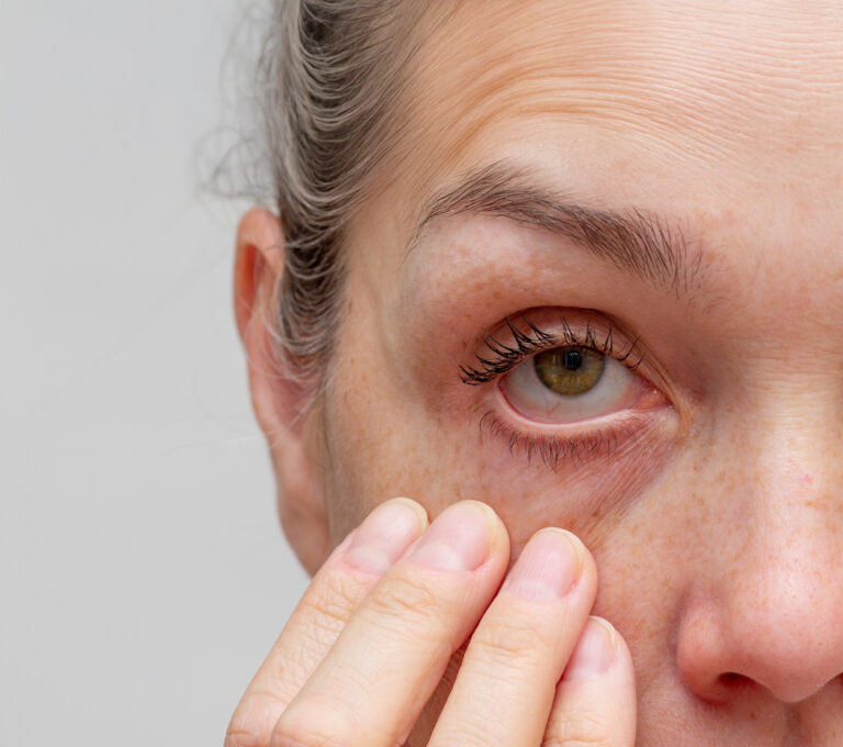 Cropped woman face with fingers under eye showing redness in eye