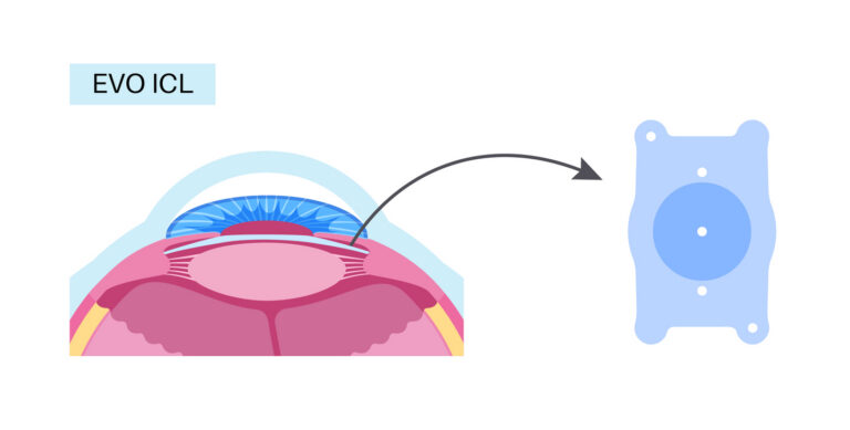 EVO ICL illustration